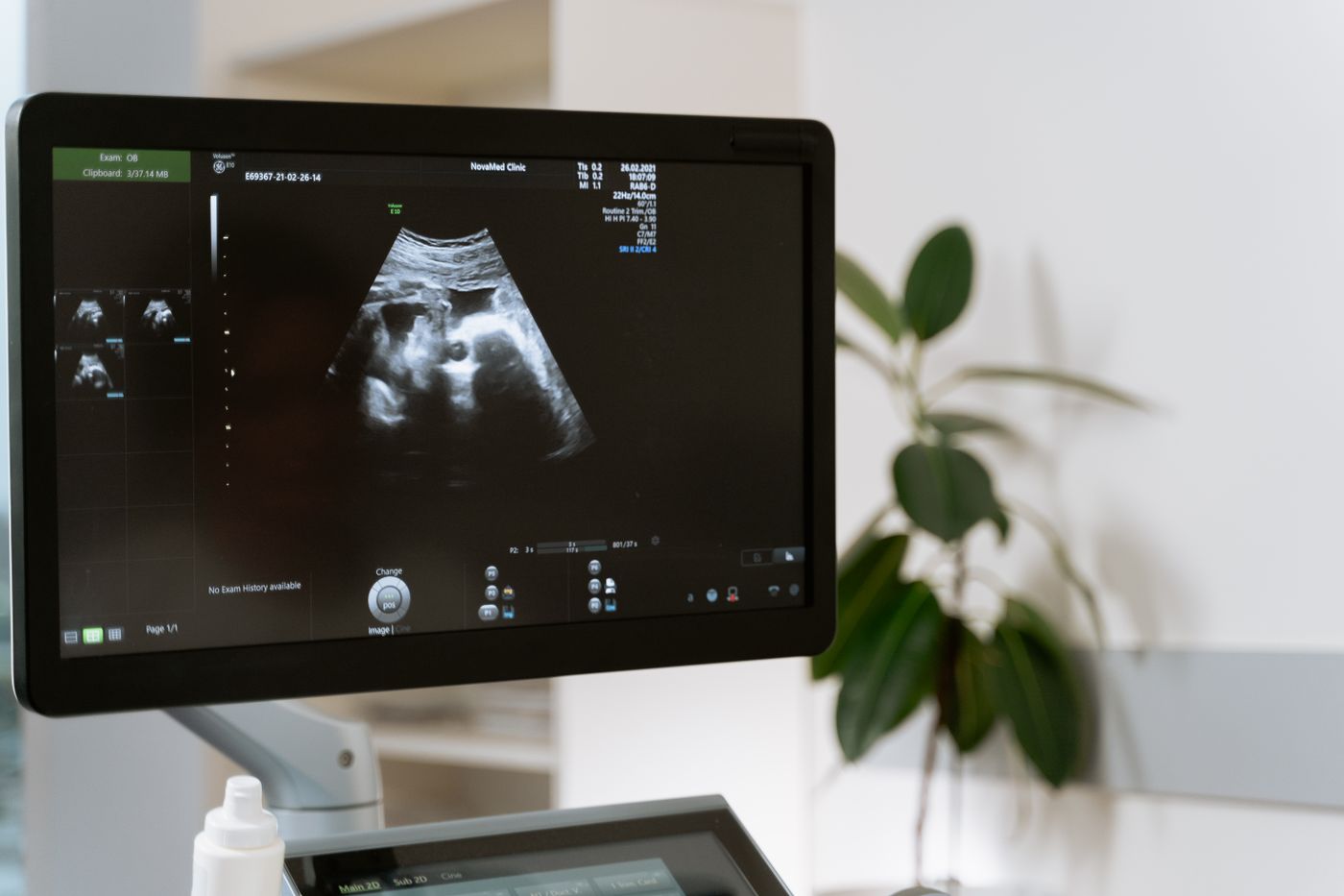 Ultrasound monitor showing a scan during antenatal assessment